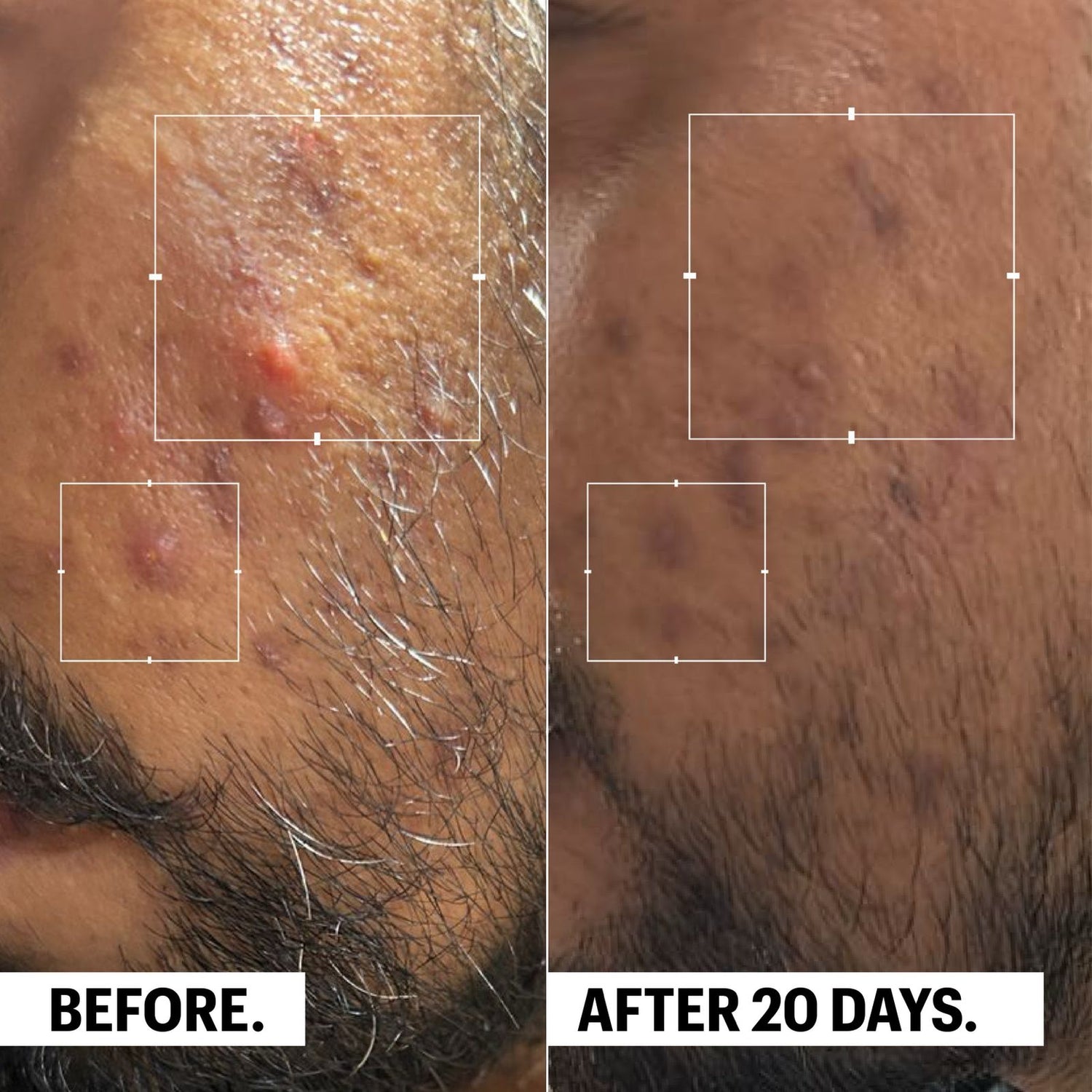 Microbalance | Multi-Action Acne Control Cream | 50ML