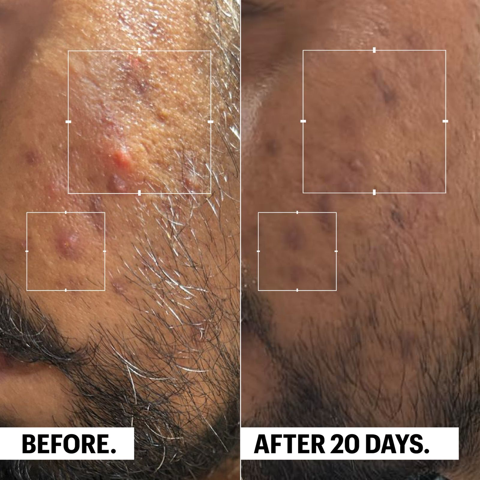 Microbalance | Multi-Action Acne Control Cream | 50ML